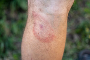 Red bullseye rash from tick bite on man's leg
